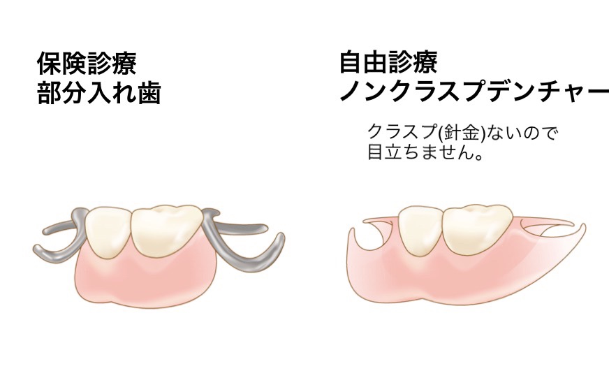ノンクラスプデンチャー